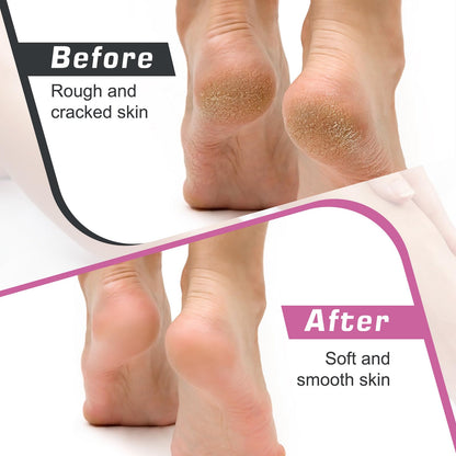 LifesLittleStepsCo Electric Foot Callus Remover